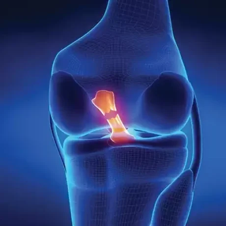 FL_TornACL_400x400