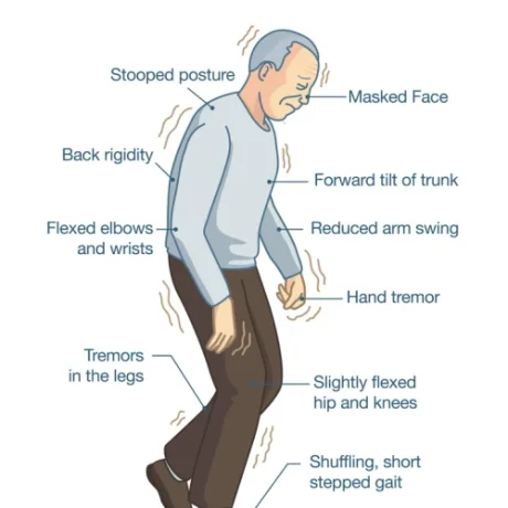 Parkinsons_sub